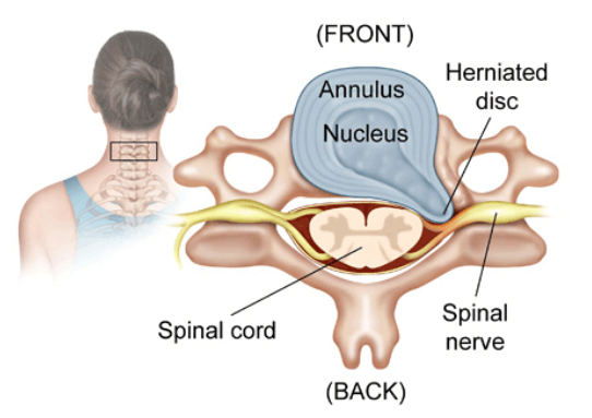 A Pain in the Neck: Types, treatment and management of neck pain | DG